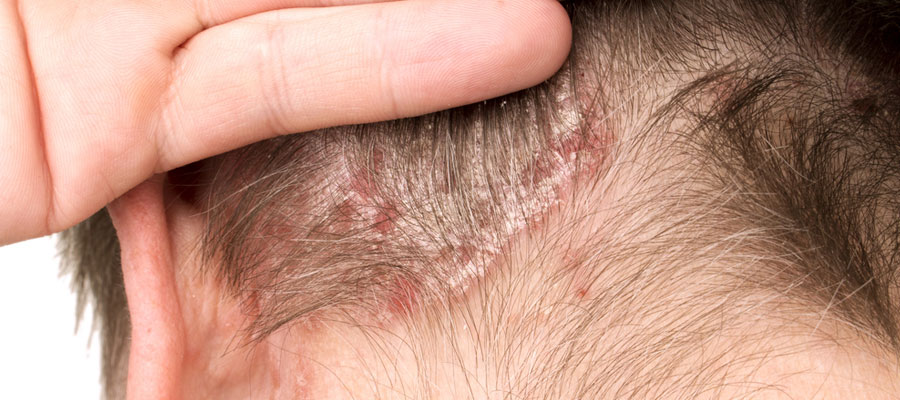 Psoriasis du cuir chevelu